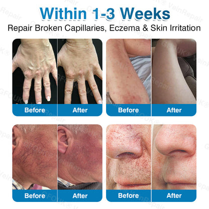 🇦🇺🏆✅️🏃GFOUK® VeinRepair Microneedle Patch Roll⚡Instant Relief, Long-Term Results