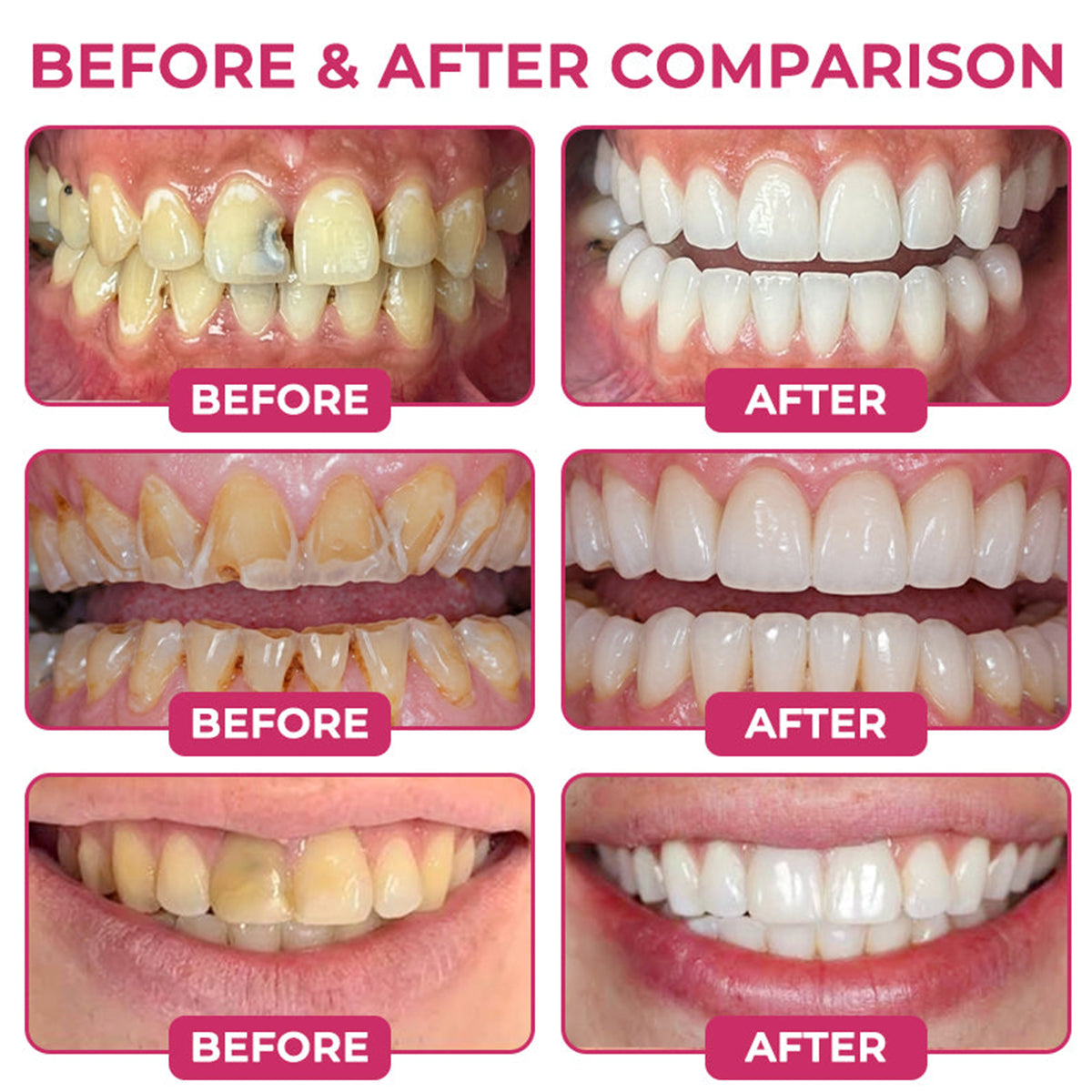 🇦🇺CureVivo® DenPerm Cavity-Repair Natural Enamel Filling Gel