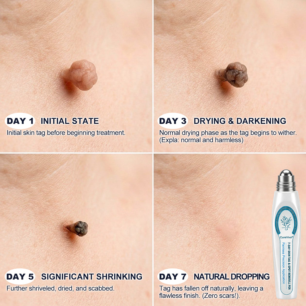 CureVivo® 7-𝐷𝑎𝑦 𝗧𝐚𝐠 & 𝗦𝗽𝐨𝐭 𝐄𝐫𝒂𝒔𝒆𝒓✅🎉(Zero Pain, Zero 𝐒𝐜𝐚𝒓𝒔 Rollerball)