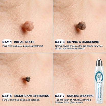 CureVivo® 7-𝐷𝑎𝑦 𝗧𝐚𝐠 & 𝗦𝗽𝐨𝐭 𝐄𝐫𝒂𝒔𝒆𝒓✅🎉(Zero Pain, Zero 𝐒𝐜𝐚𝒓𝒔 Rollerball)