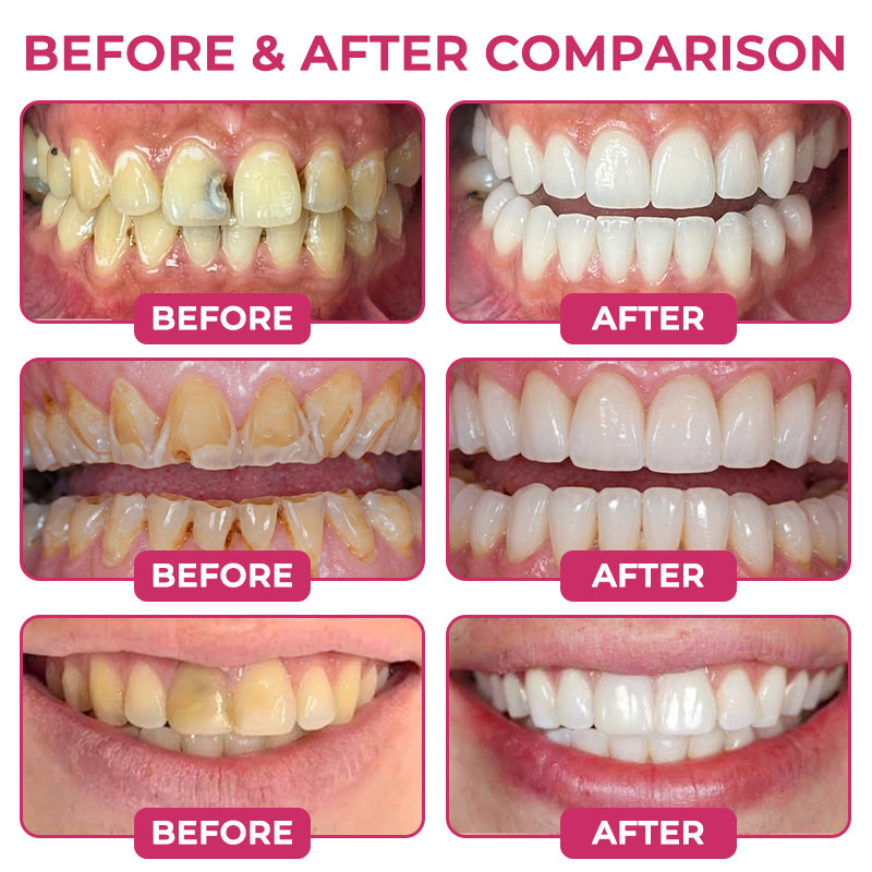 🇺🇸Rolimey® DenPerm Cavity-Repair Natural Enamel Filling Gel
