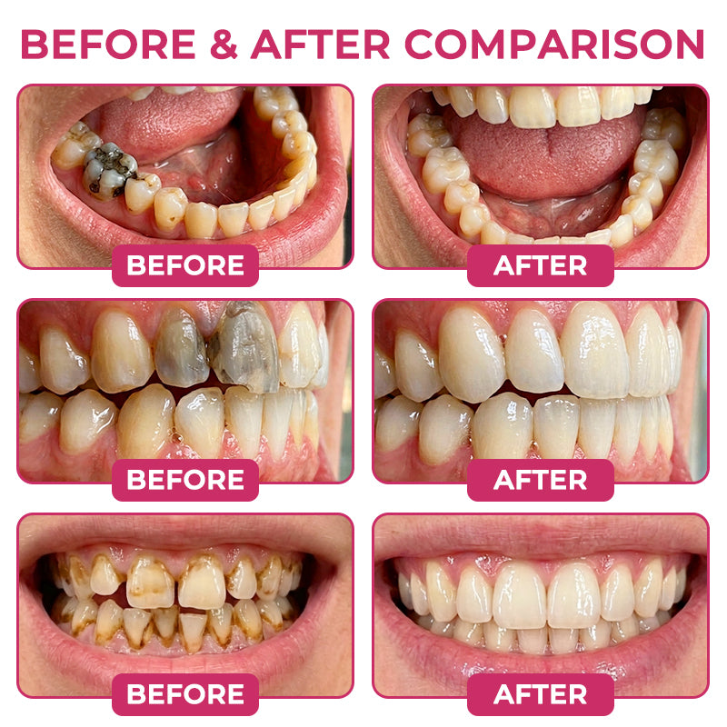 🇺🇸Rolimey® DenPerm Cavity-Repair Natural Enamel Filling Gel